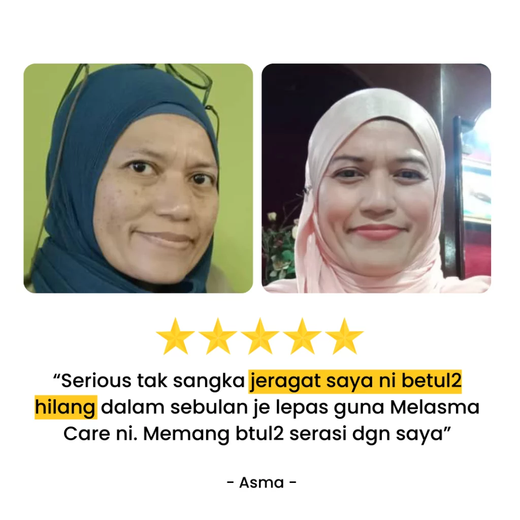 Testimoni-Melasma-Care